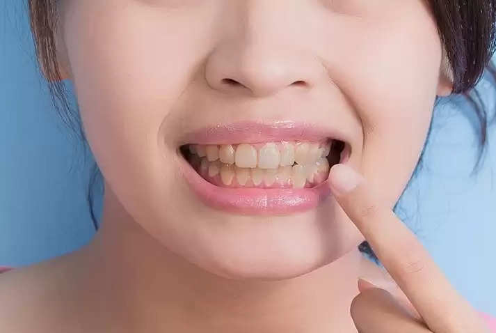 Teeth Care: अगर दांतों  का पीलापन छीन रहा है आपकी हंसी, तो ऐसे चमकाएं अपने दांत