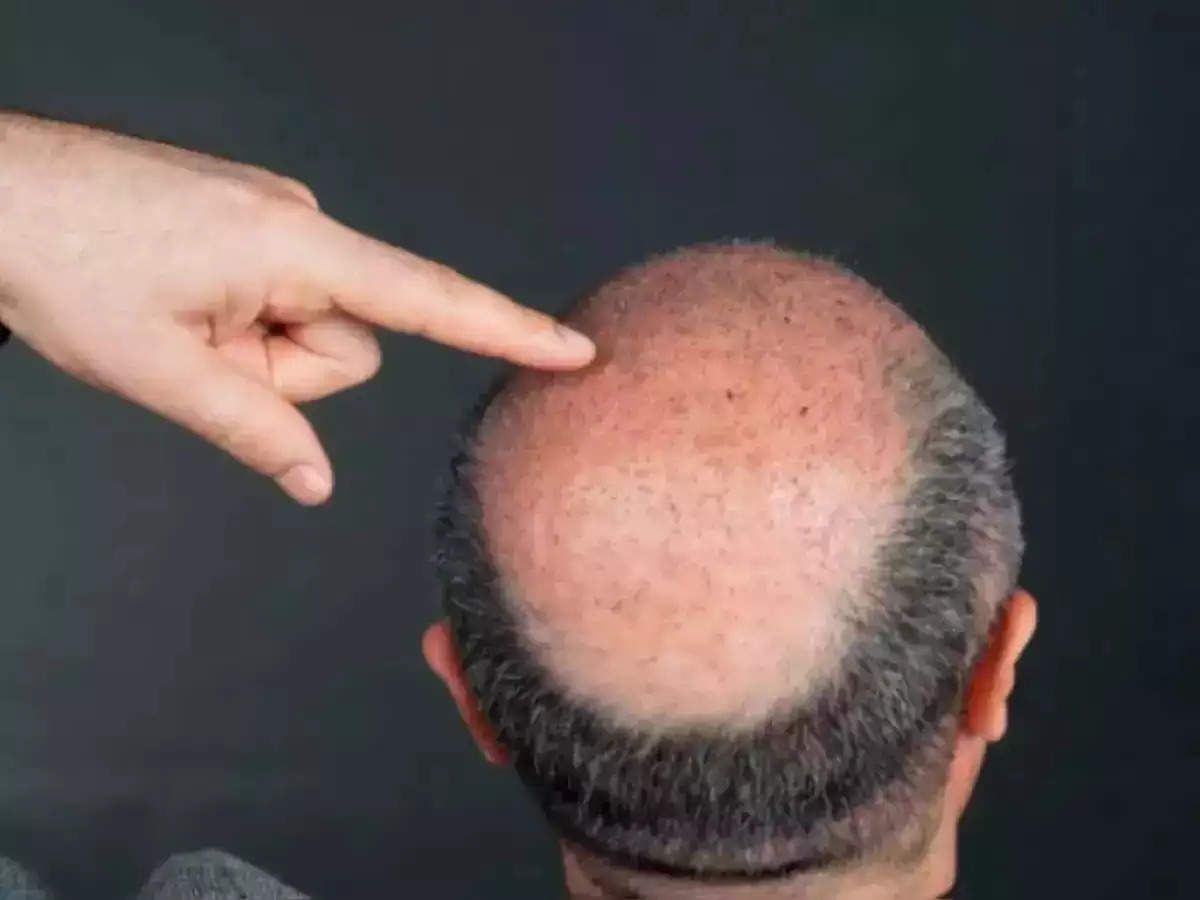 Lifestyle: गंजे सिर पर कैसे उगाएं बाल, वैज्ञानिकों ने नए शोध में बताया ये कारगर तरीका