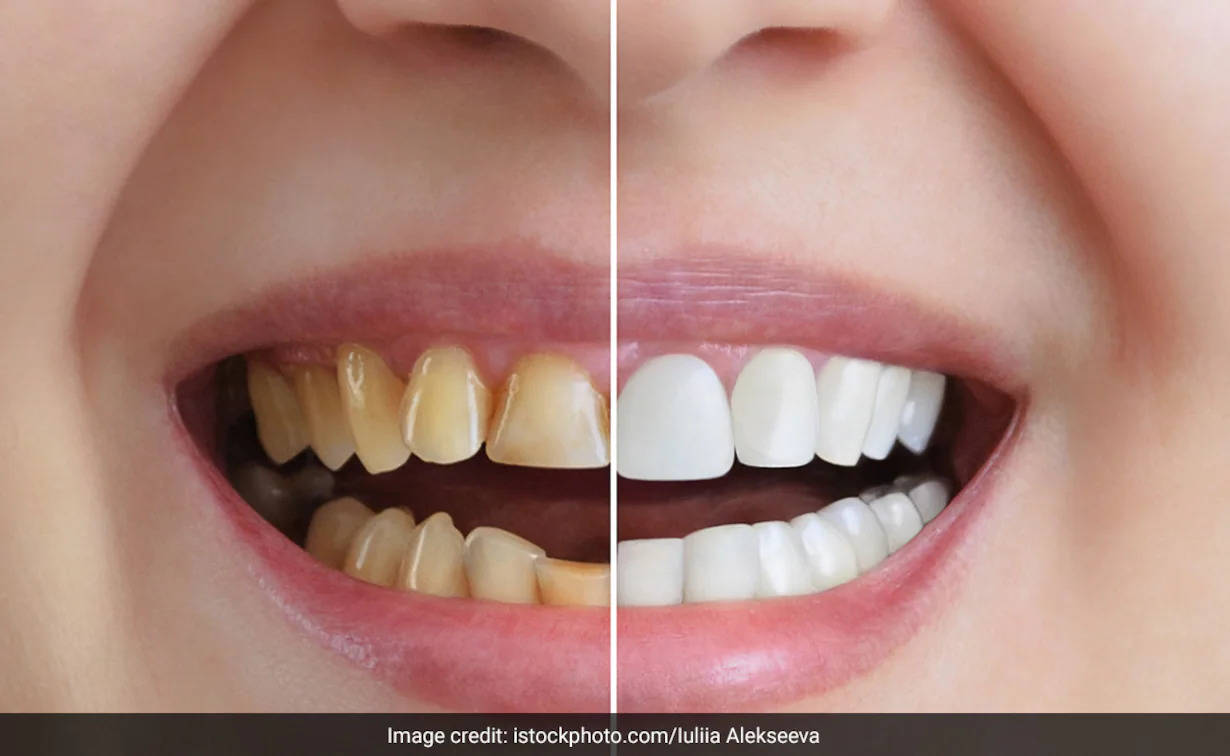 Lifestyle: अगर दांत पीले हो गए हैं और गंदे दिखने लगे हैं और मुस्कुराने में भी झिझक होती है तो ये 5 चीजें दांतों का पीलापन तुरंत कर देंगी दूर