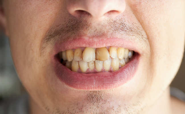 Lifestyle: अगर दांत पीले हो गए हैं और गंदे दिखने लगे हैं और मुस्कुराने में भी झिझक होती है तो ये 5 चीजें दांतों का पीलापन तुरंत कर देंगी दूर