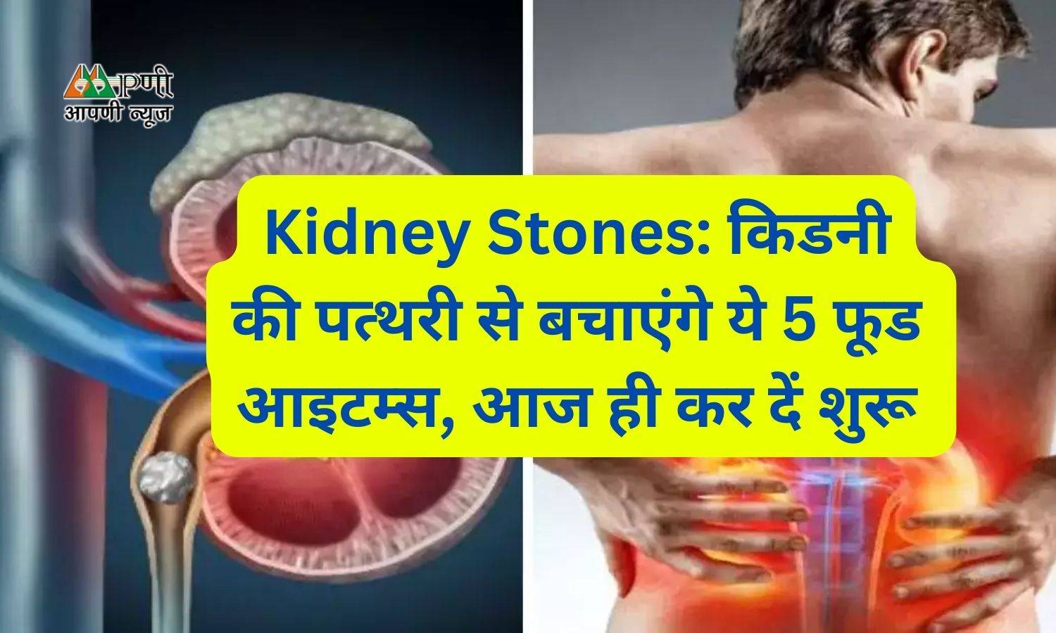 Kidney Stones: किडनी की पत्थरी से बचाएंगे ये 5 फूड आइटम्स, आज ही कर दें शुरू