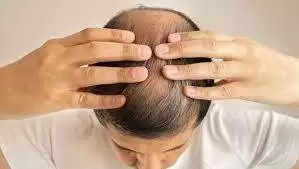 Lifestyle: गंजे सिर पर कैसे उगाएं बाल, वैज्ञानिकों ने नए शोध में बताया ये कारगर तरीका