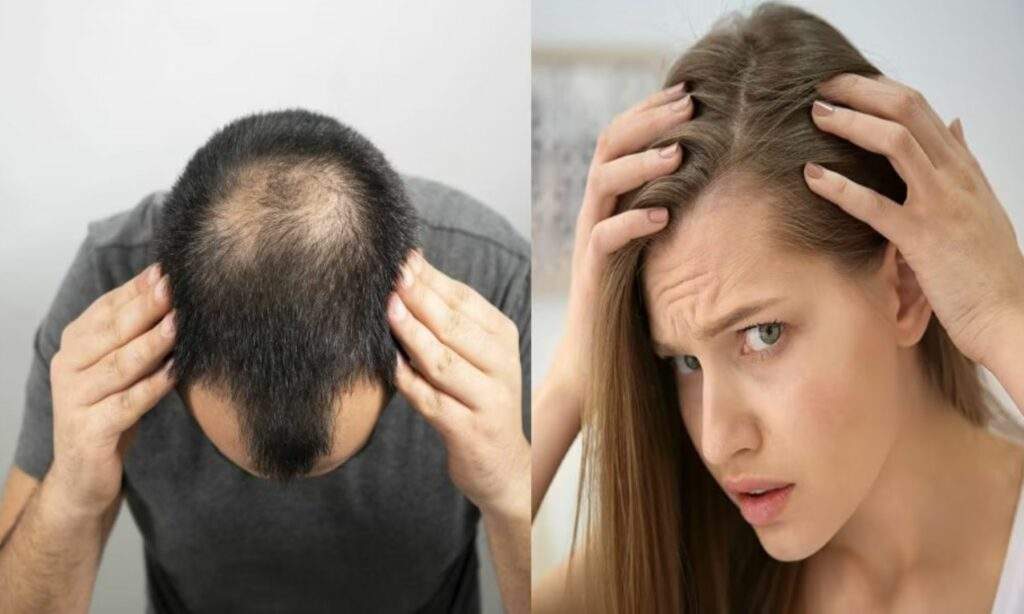 Hair Loss Causes: इन कारणों से झड़ने लगते हैं बाल, जानें गंजापन रोकने का समाधान